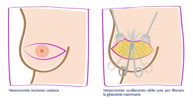 disegno che spiega come si esegue una mastectomia